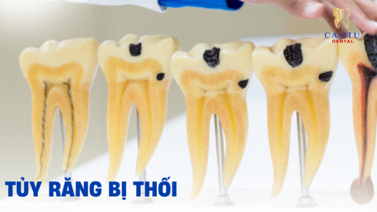 Sâu răng nặng nhưng không đi điều trị