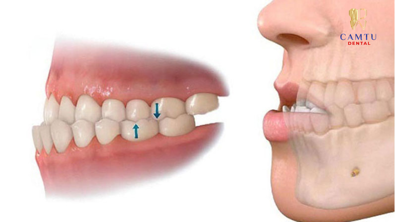 Điều trị khớp cắn để giảm tình trạng mòn cổ chân răng