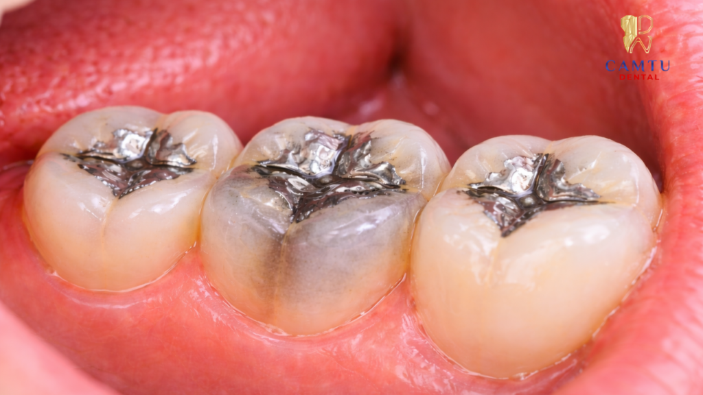 Có thể gây đổi màu răng theo thời gian