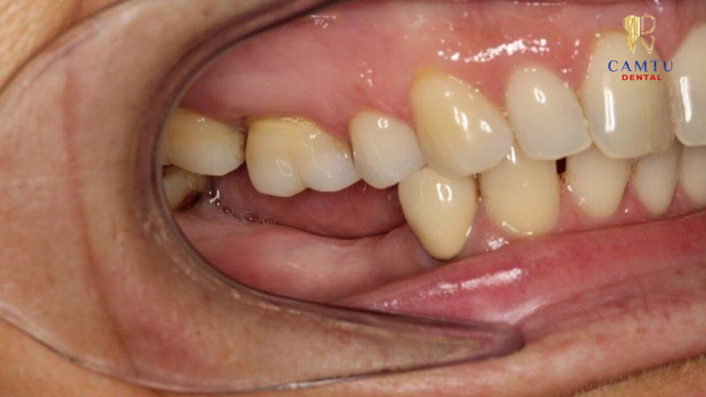 Tình trạng và mức độ nguy hiểm của tiêu xương răng