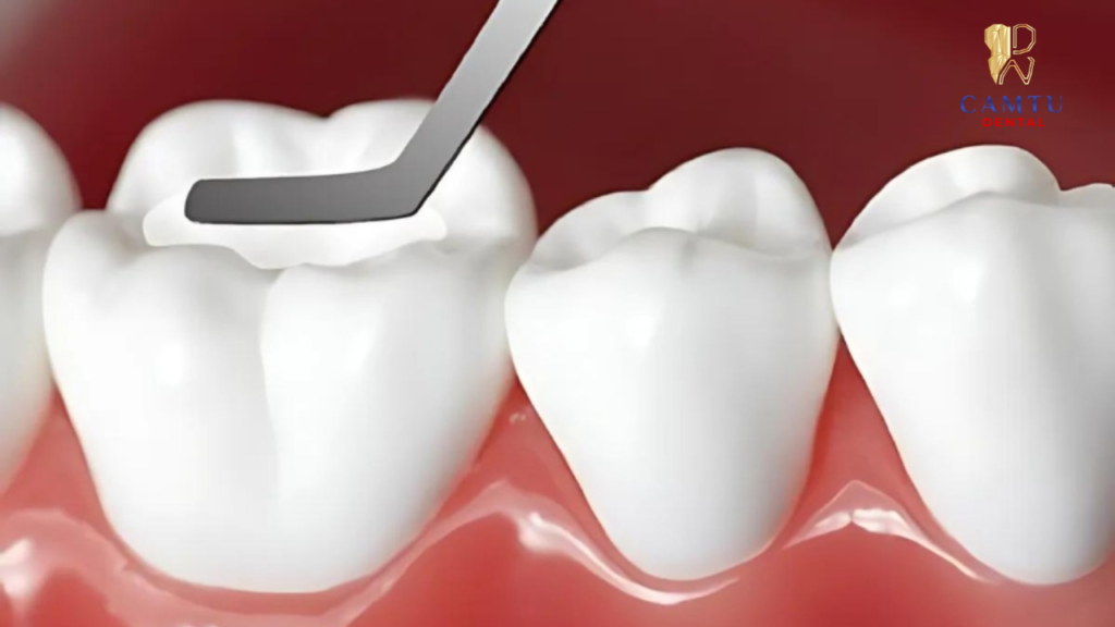 Tạo hình và đặt vật liệu composite