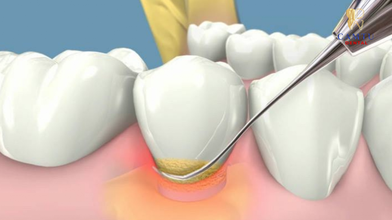 Có 3 mức độ mòn cổ chân răng 