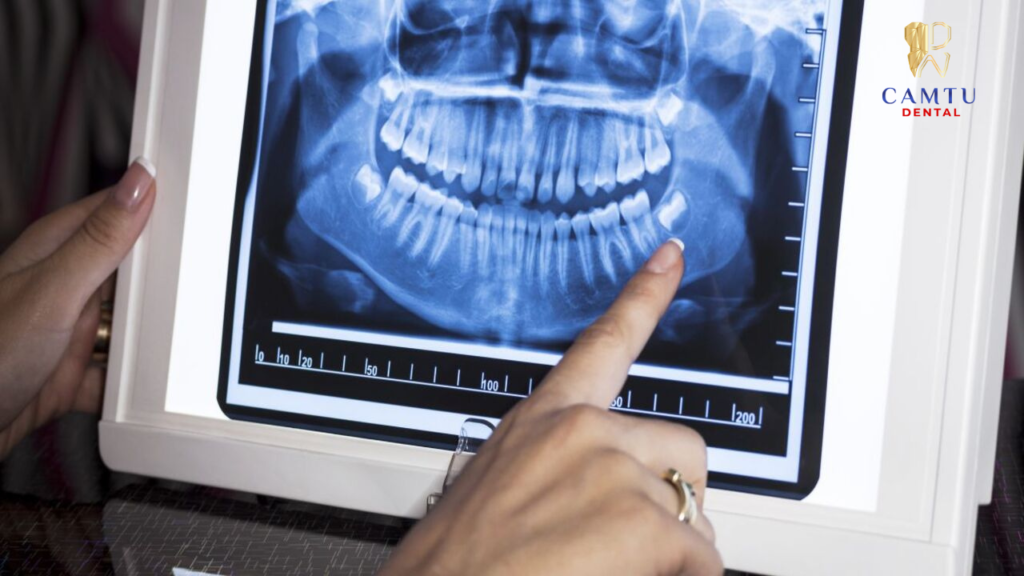 Chụp X Quang răng để đánh giá độ phức tạp