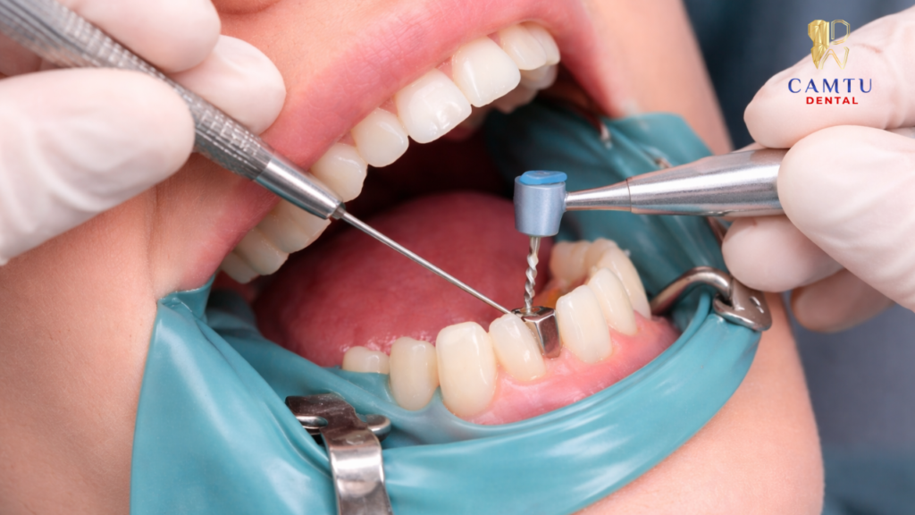 Thao tác điều trị tủy răng tại phòng khám nha khoa