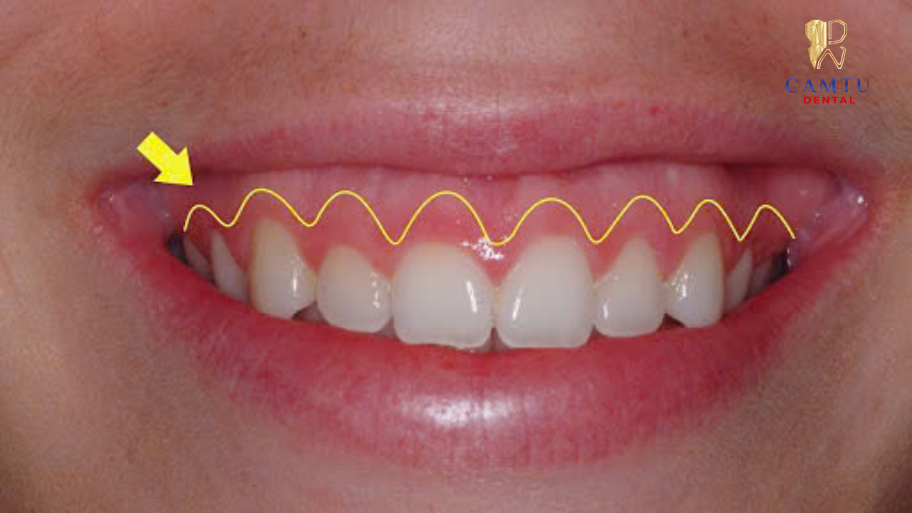 Thời gian phục hồi sẽ phụ thuộc vào mức độ phục hình