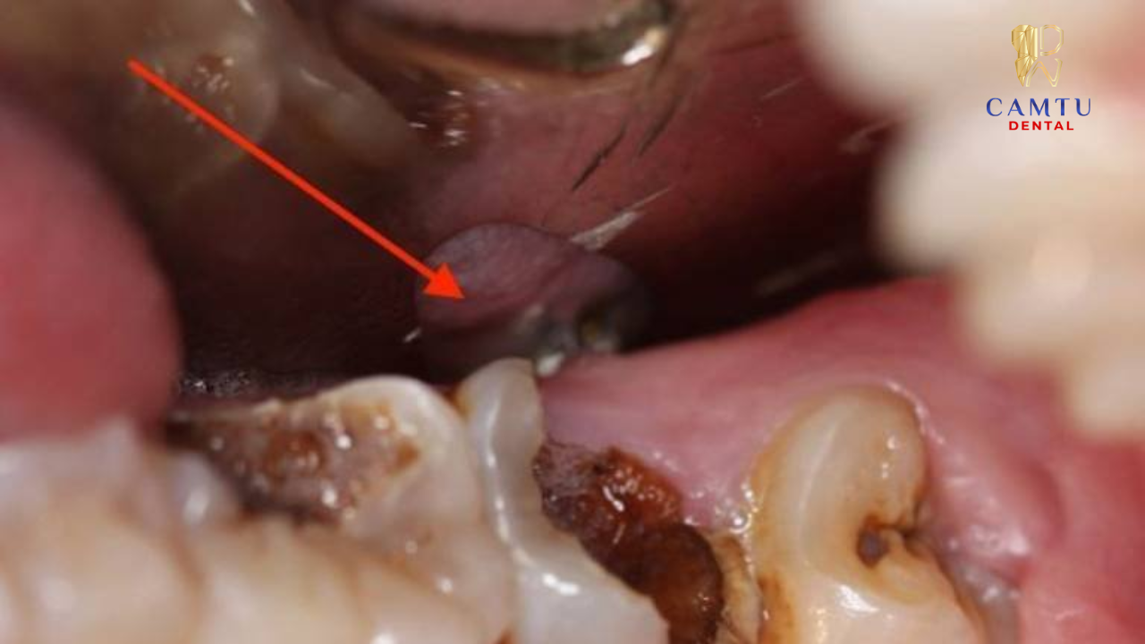 Sẽ nguy hiểm nếu bạn không chữa trị kịp thời