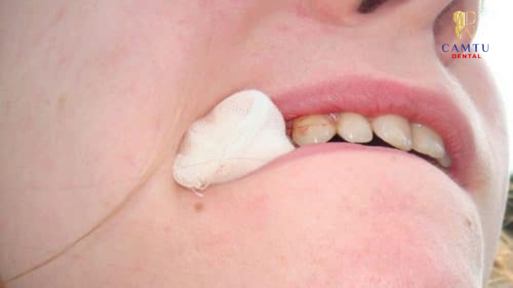 Tạo áp lực để cầm máu và ổn định răng