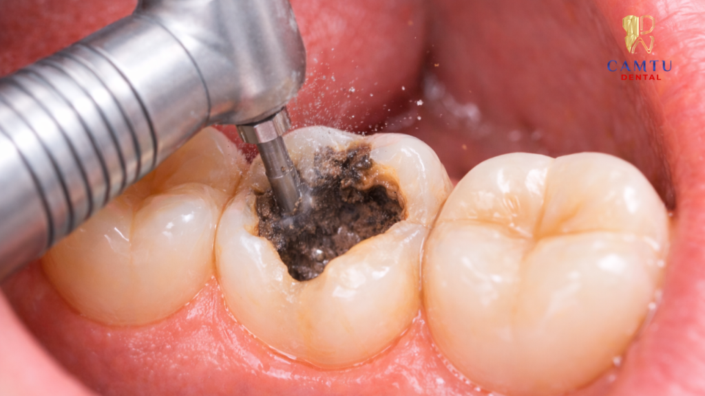 Tạo hình xoang trám