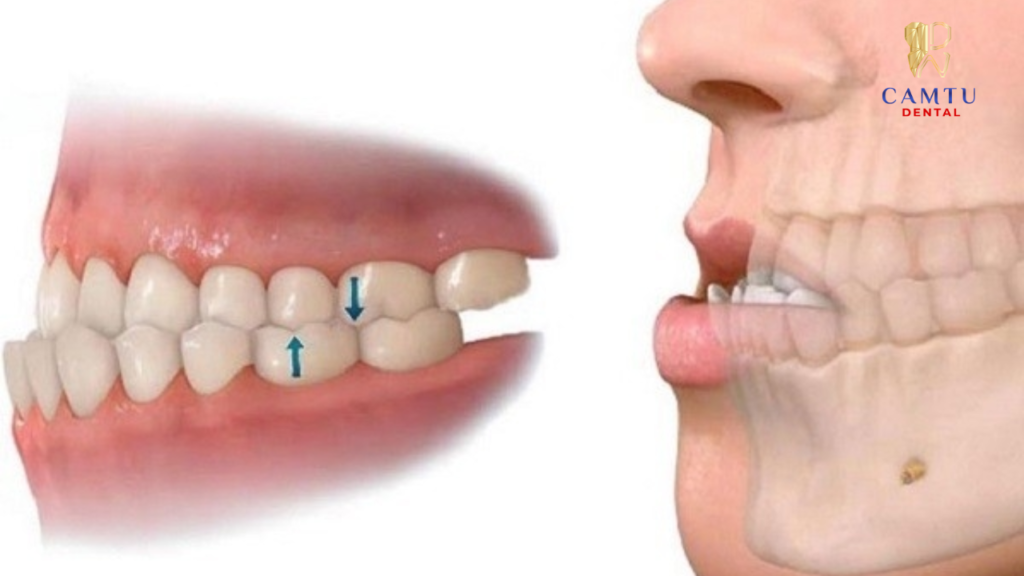 Điều chỉnh khớp cắn và đánh bóng