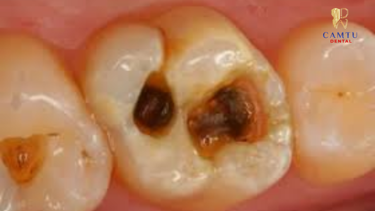 Đau răng kéo dài hoặc âm ỉ thì bạn nên đi khá