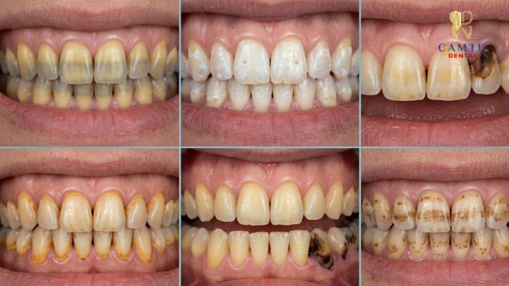 Các dạng răng bị đổi màu thường gặp