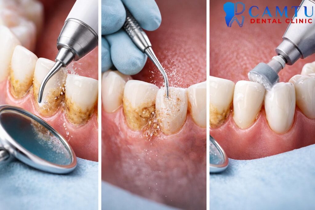 Các phương pháp lấy cao răng phổ biến hiện nay