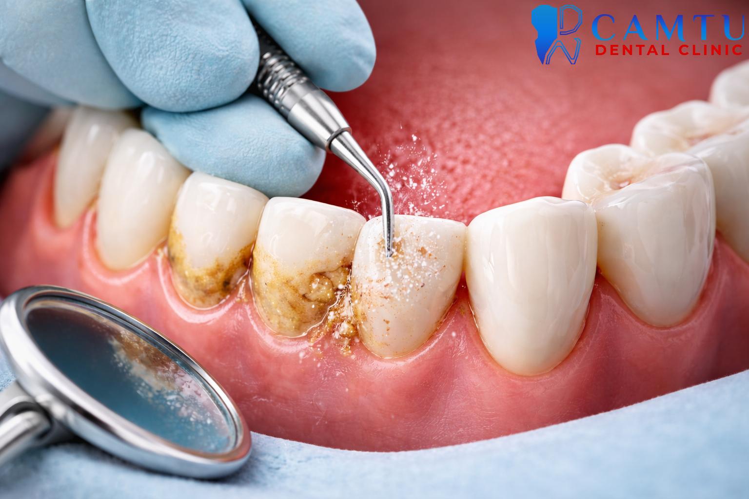 Lấy cao răng thủ công