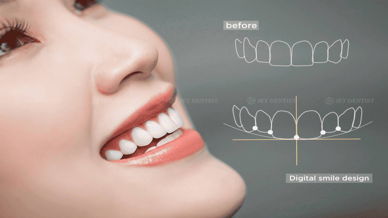 Công nghệ thiết kế tạo nụ cười Smile Digital Design