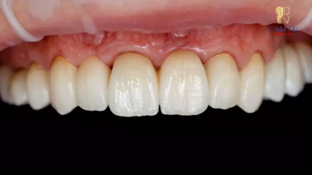 Viền xám nhạt dưới nướu mỏng là dấu hiệu bọc sứ bị đen nướu