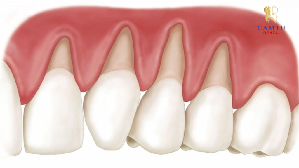 Gây ra tình trạng tụt lợi, răng bị lung lây