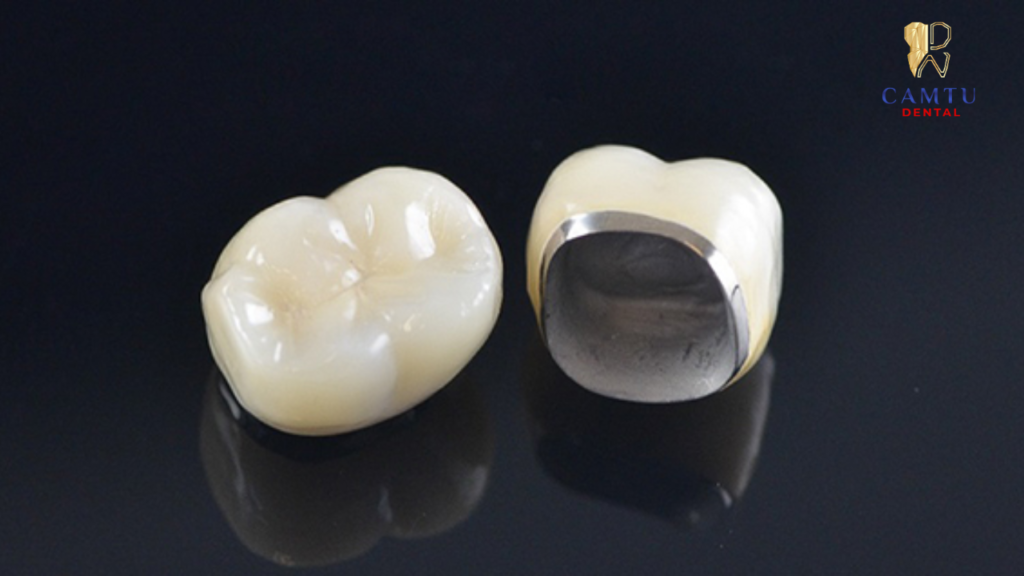 Răng sứ kim loại gây đen viền nướu