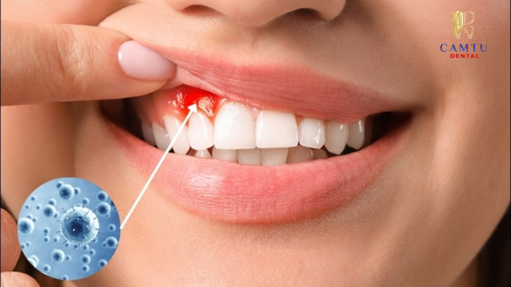 Nướu răng mỏng, cơ địa nhạy cảm