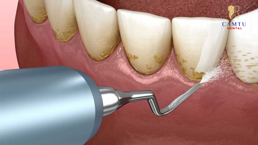 Gạo vôi răng và đánh bóng