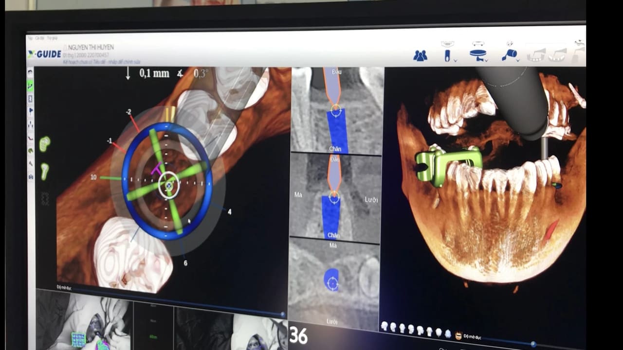 Cấy ghép răng bằng robot định vị 
