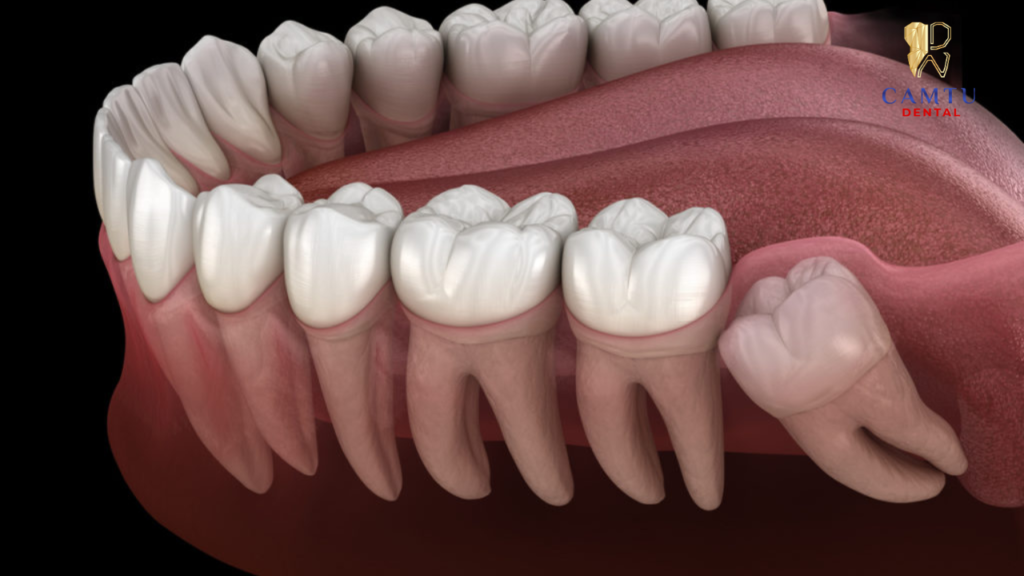 Trong vòng 24h chảy máu sau khi nhổ răng khôn là hiện tượng bình thường