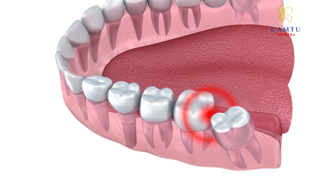 Nguyên nhân chảy máu sau khi nhổ răng có thể đến từ vị trí mọc răng