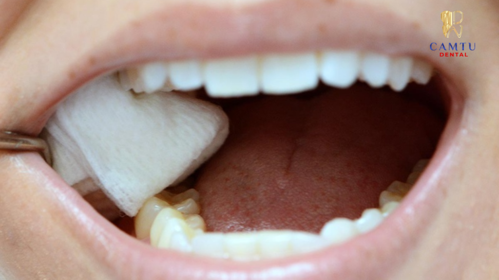 Cầm gạc để ngăn máu chảy