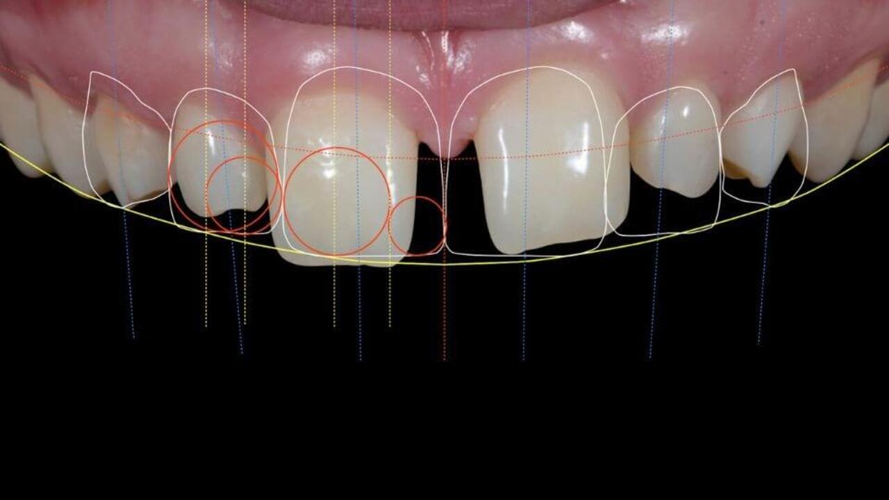 Khám phá quy trình thiết kế nụ cười giúp bạn tự tin