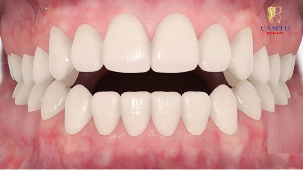 Hình minh họa khớp cắn hở