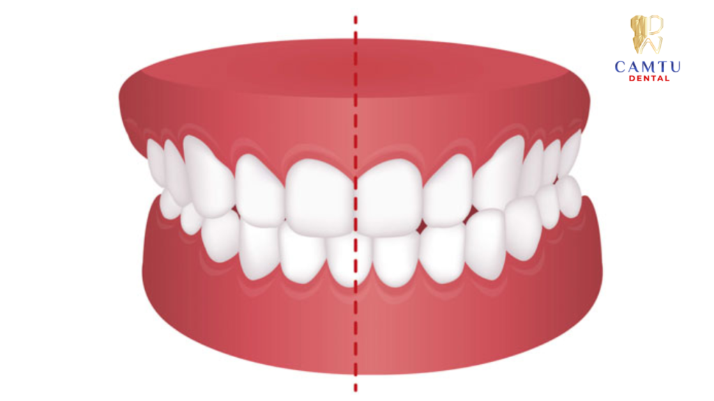 Hình minh họa khớp cắn chéo 
