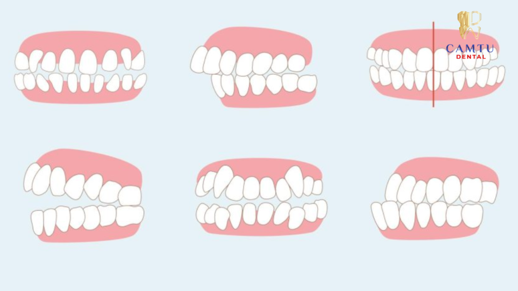 Kiểm tra khớp cắn đơn giản tại nhà