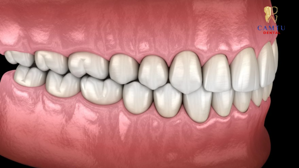 Răng hàm trên và răng hàm dưới tiếp xúc hài hòa