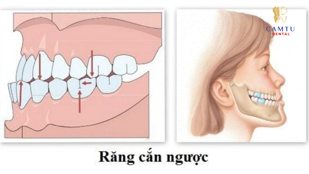 Hình minh họa khớp cắn ngược