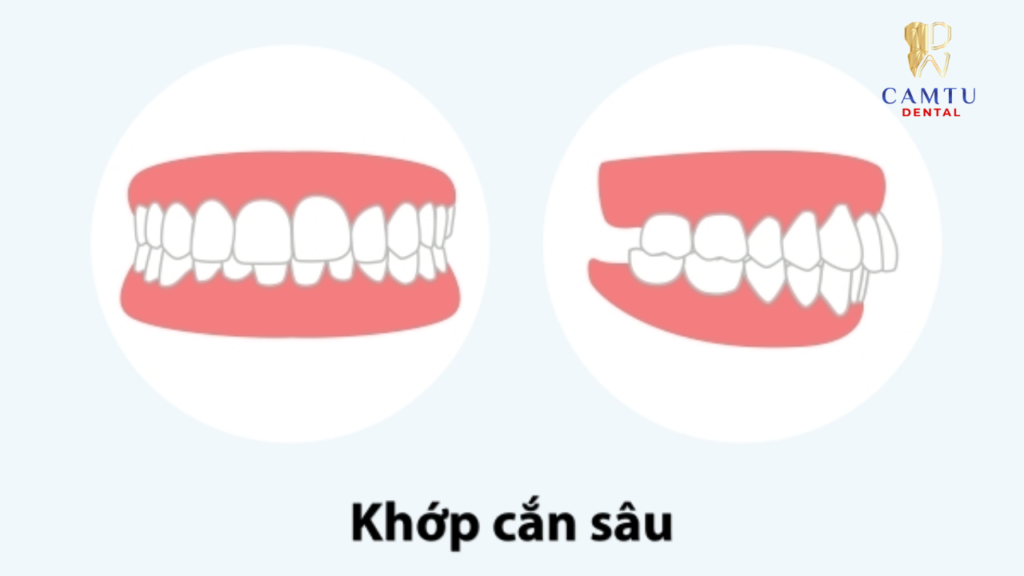 Hình minh họa khớp cắn sâu