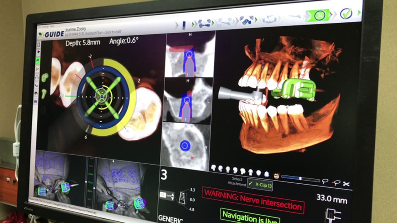 Nguyên lý định vị Implant bằng công nghệ X Guide