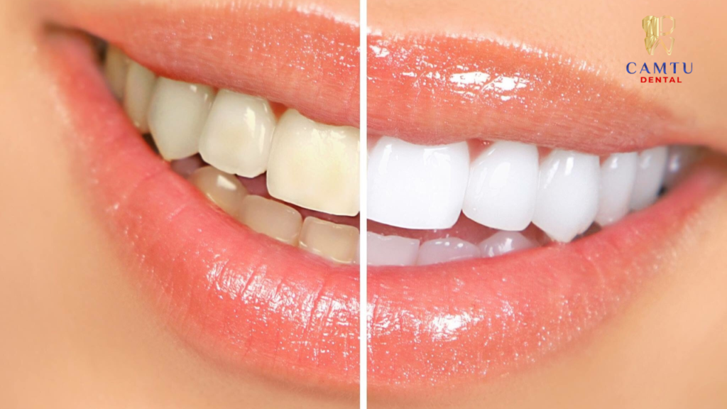 Tẩy trắng răng là phương pháp giúp hàm răng trắng sáng