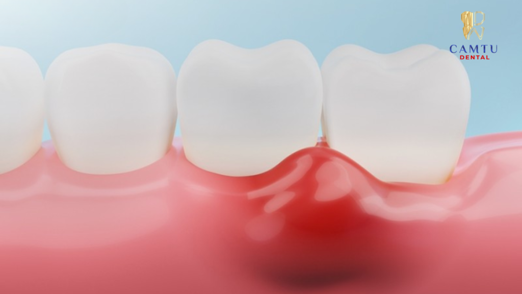 Ảnh hưởng đến mô nướu gây viêm đỏ khi tẩy trắng răng quá mức
