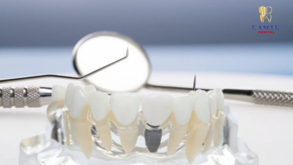 implant hoạt động như thế nào