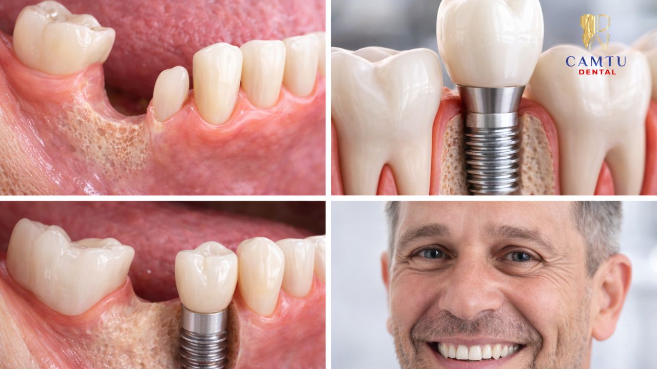 Quy trình cấy ghép trụ implant