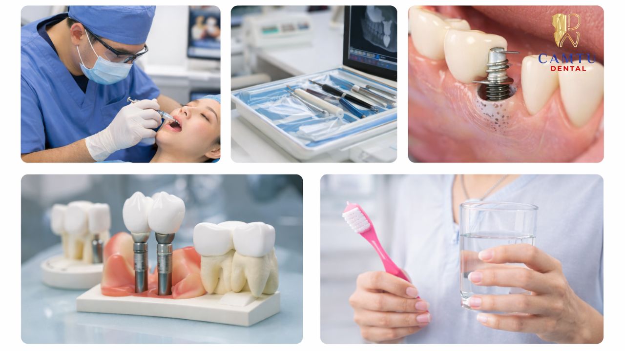 Các yếu tố ảnh hưởng đến trồng răng