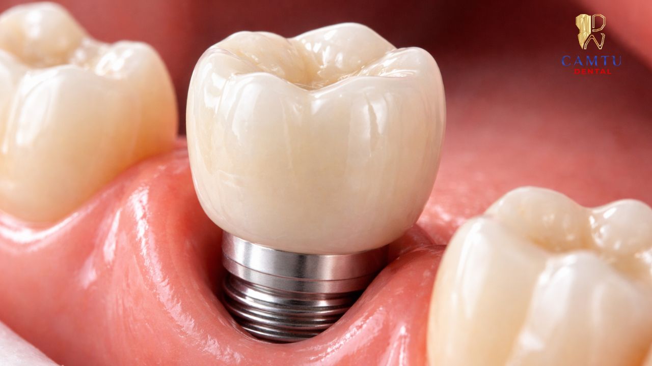 Thành phần của mão răng sứ implant