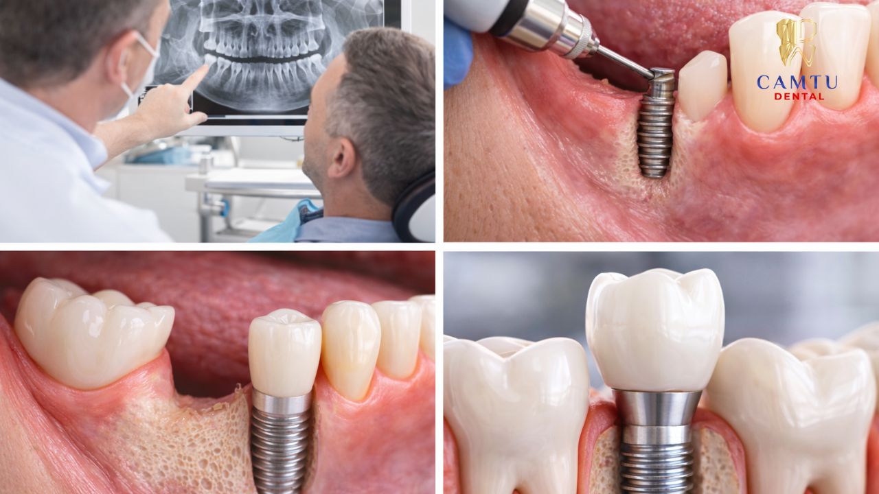 Lợi ích của việc cấy ghép răng