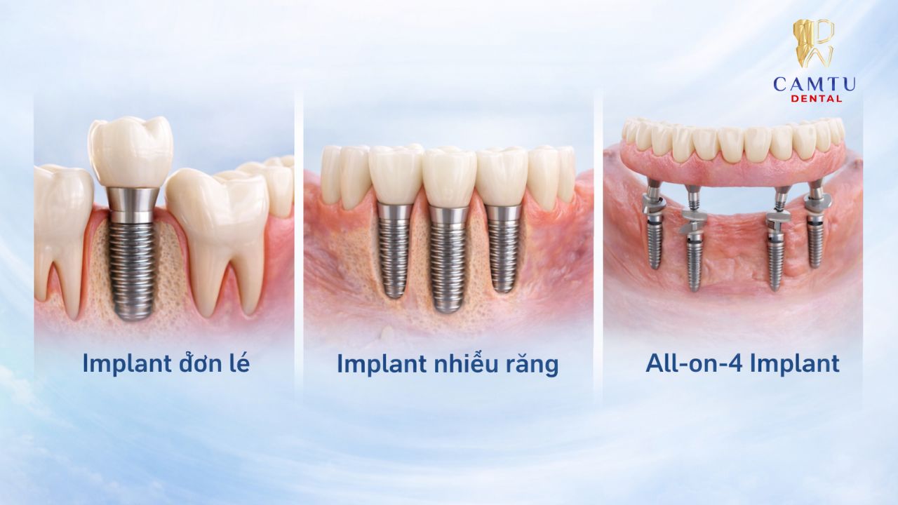 Giải pháp implant nha khoa