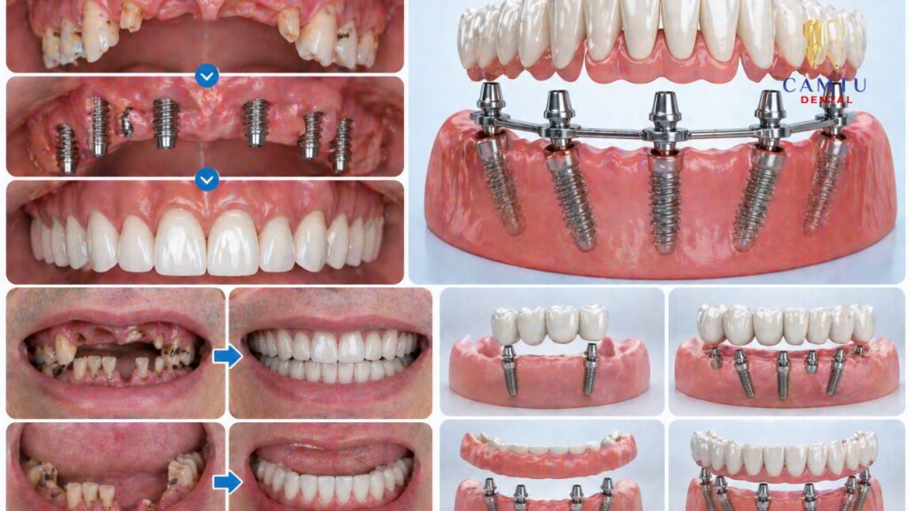 mất nhiều răng trồng implant