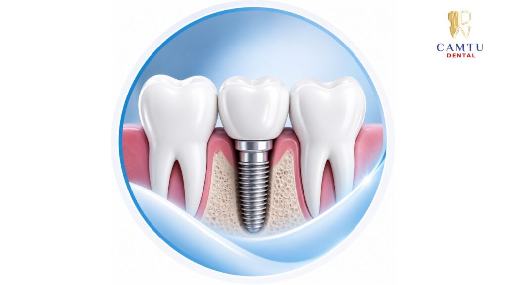 Trồng implant có thay thế răng thật được không