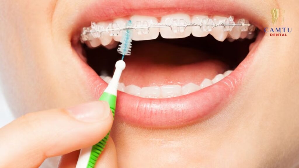 Bàn chải chỉnh nha được thiết kế chuyên biệt dành cho người đang niềng răng với phần lông có rãnh chữ V ở giữa