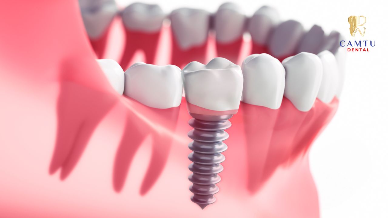 Sau trông Implant là giai đoạn nhạy cảm nên phải chú ý đến ăn uống