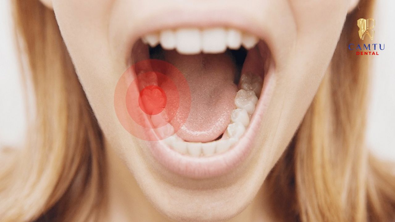 Cơn đau kéo dài và sưng viêm xung quanh khu vực trồng Implant