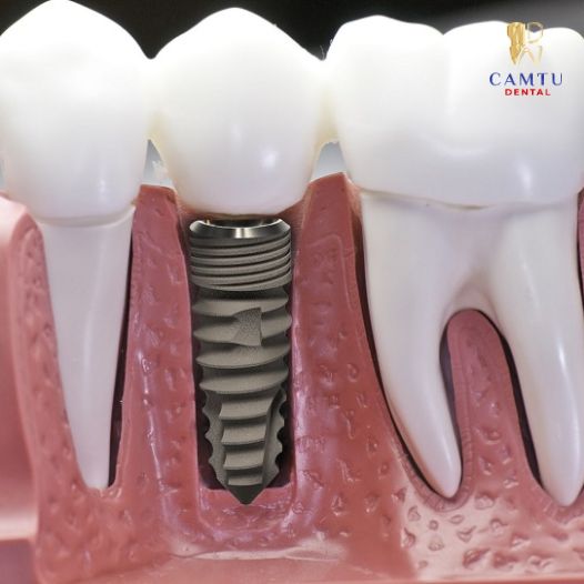 Implant có bền không? Tuổi thọ Implant thực tế là bao lâu?