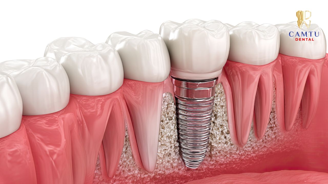 Hình ảnh mô tả cấu tạo và độ bền của răng Implant cấy ghép
